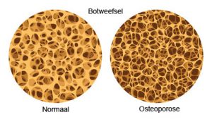 osteoporose2